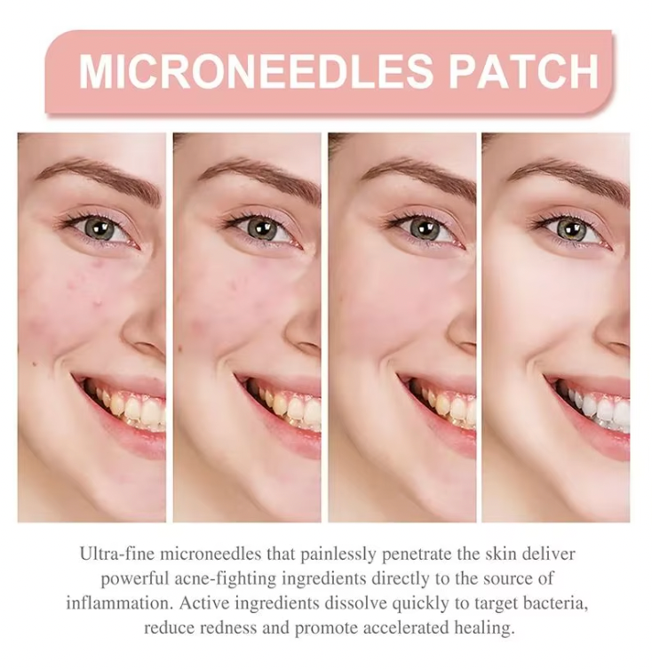 ClearSkin Pimple Patches before and after progression showing skin improvement with microneedle technology for acne treatment